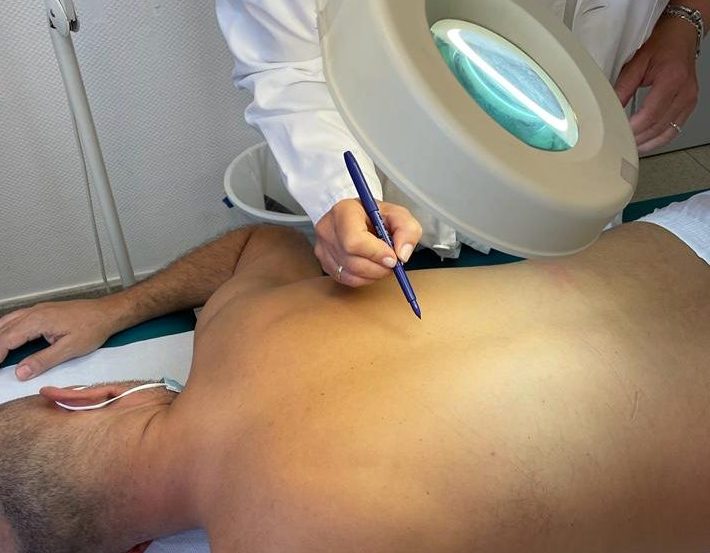diagnostico melanoma